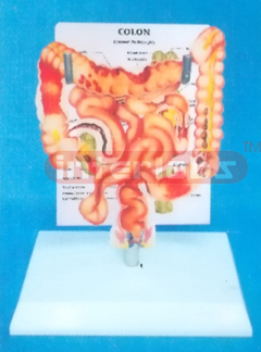 DESK TYPE HUMAN COMMON PATHOLOGIES OF THE INTESTINES SYSTEM WITH DESCRIPTION PLATE